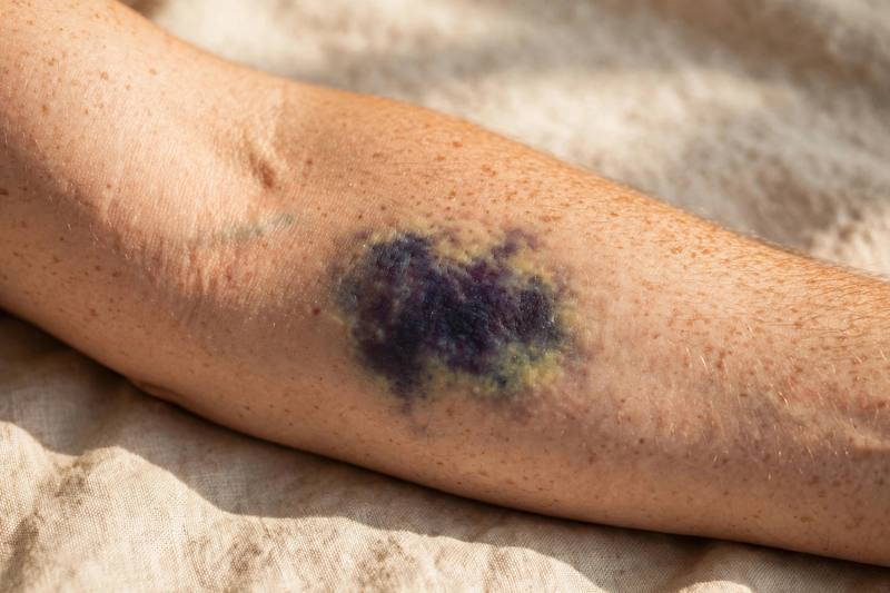 bruise